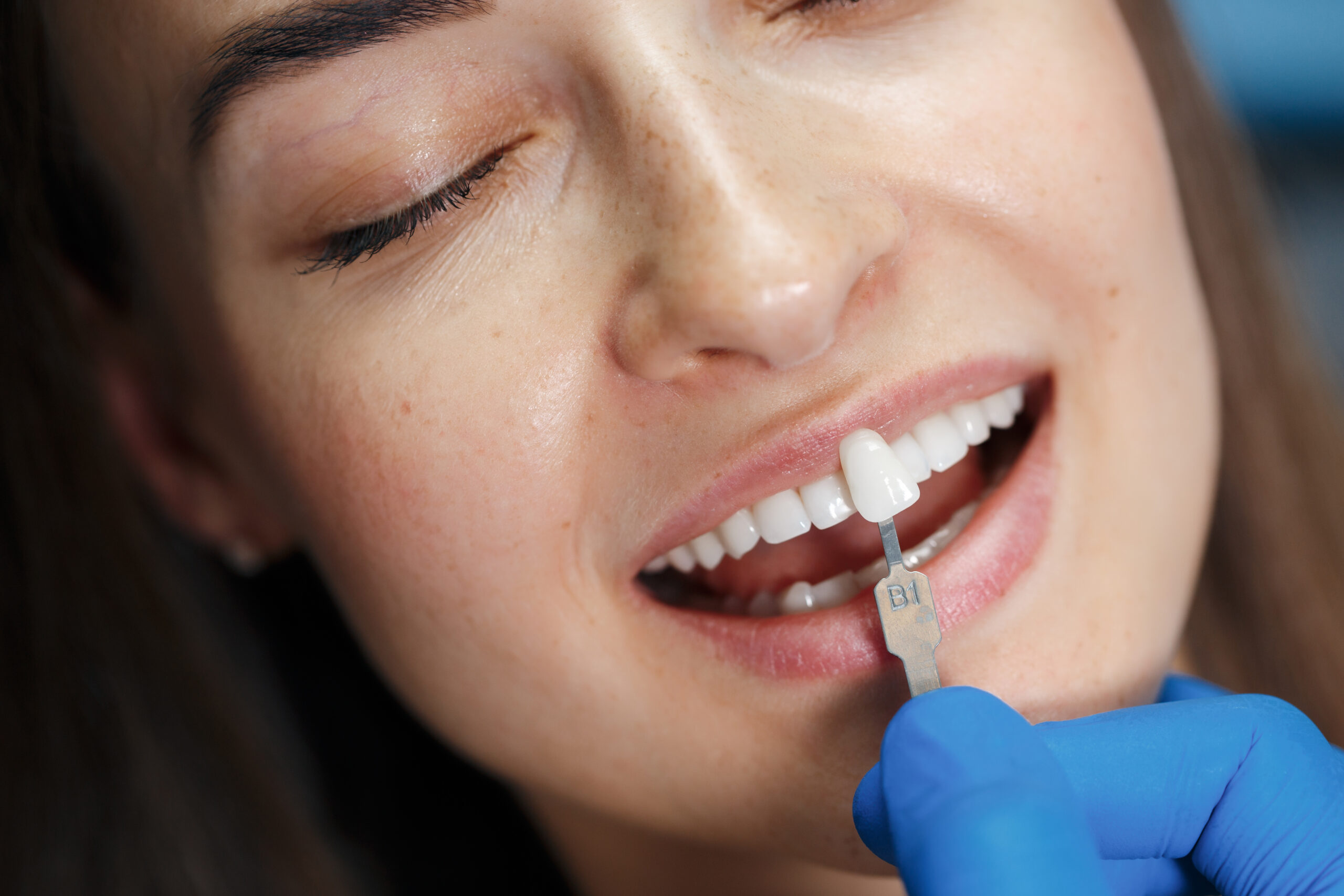 Top Benefits of Dental Veneers Over Other Cosmetic Dental Treatments